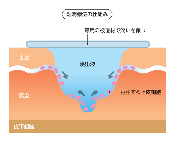 傷口からの浸出液を封じ込める湿潤療法の仕組み