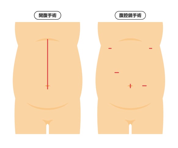 開腹手術と腹腔鏡手術の傷口の違い