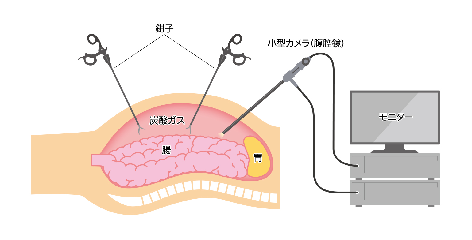 身近な病気ほど負担の少ない手術に｜学習ブログ｜ASP Japan合同会社 サムネイル画像